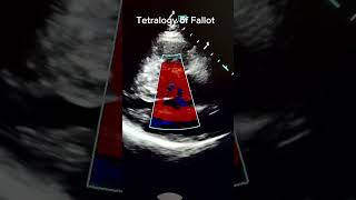 Tetralogy of Fallot cardiology echocardiography [upl. by Gloria]