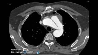 Disección de aorta y arteria carótida [upl. by Glavin954]