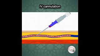 💉 INTRAVENOUS IV CANNULATION ANIMATION [upl. by Lotson769]