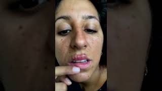 Cystic acne and blackheads removal  Newest pimple pops for 2022 [upl. by Sharon]