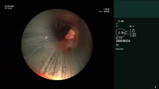 POST INTUBATION TRACHEAL STENOSIS DILATATION STENT REMOVAL HOUR GLASS SILICON STENT INSERTION [upl. by Llenyar]