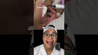 Carillas dentales conócelas dientes dentista tips parati viral fyp shorts shortvideo fypシ [upl. by Hulton]