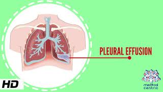 Pleural Effusion Causes Signs and Symptoms Diagnosis and Treatment [upl. by Murray]