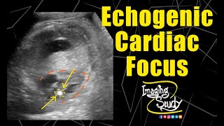 Fetus Ultrasound Echogenic Intracardiac Focus [upl. by Eelaroc]