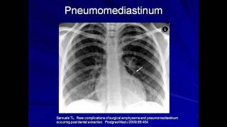 Lung Protective Ventilation Mechanical Ventilation  Lecture 9 [upl. by Yznel]