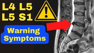 WARNING These Are The 3 MAJOR Symptoms of a Severe L4 L5 L5 S1 Disc Bulge  Dr Walter Salubro [upl. by Emad720]