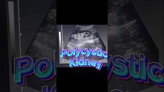 Polycystic Kidneys  Renal Cysts  Kidney Cysts on ultrasound [upl. by Niatsirhc427]