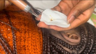 Massive Ear Wax removal Short video asmrvideos earcleaningasmr ear earwaxremoval earcleaning [upl. by Blim628]