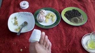 CHAMPIGNON DES ONGLES TRAITEMENT NATUREL معالجة فطر أظافر القدمين [upl. by Obadias]