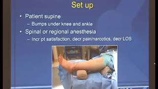 Arthroscopic Ankle Arthrodesis [upl. by Salb]