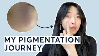 How I got rid of my pigmentation amp dark spots  PicoWay Resolve [upl. by Aibara]