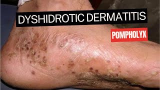 Dyshidrotic Eczema Pompholyx [upl. by Eenram]