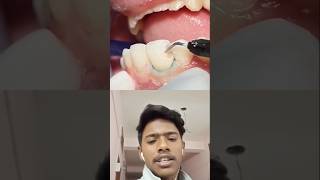 how to treat teeth drilling teeth rct viralreels trending viralytshorts viralshorts dentist [upl. by Alberik]