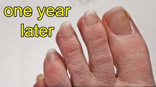 Repainting my Toe Nails After 1 Year of Growing Them Out [upl. by Airdni]