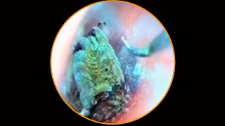 Satisfying Ear Wax Removal With Dr Zhao Video 60 [upl. by Ynohtnaleahcim785]