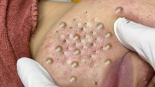 Big Cystic Acne Blackheads Extraction Blackheads amp Milia Whiteheads Removal Pimple Popping  3881 [upl. by Kreit620]