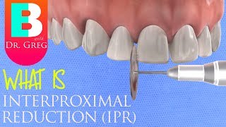 Interproximal Reduction IPR Stripping of Teeth for Braces or Invisalign [upl. by Harli]