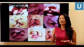 Cleft Care 101 What to expect when your child has a cleft lip or palate  UCLAMDChat [upl. by Cope]