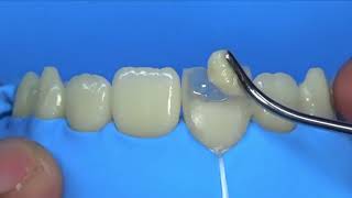 Step By Step Direct Composite Restoration Central Incisor [upl. by Iaht]