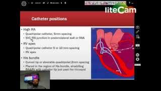 Basic Electrophysiologic Study [upl. by Modla]