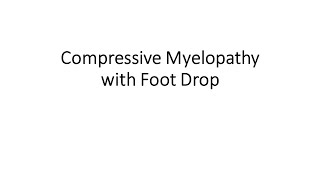 Compressive Myelopathy with Foot Drop [upl. by Thekla]