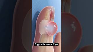 Digital mucous cyst explained 3D Animation [upl. by Farmer638]