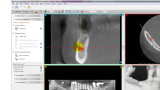 Owandy SIMPLANT Tutorial Overview [upl. by Anirrak]