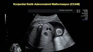 Konjenital kistik adenomatoid malformasyon CCAM tip 1 2 [upl. by Coit]