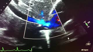 IVC 2d echo with color flow doppler of the inferior vena cava wcollapse [upl. by Ataynek]