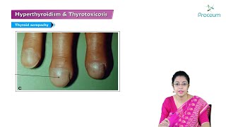 Hyperthyroidism amp Thyrotoxicosis Hindi  Internal Medicine [upl. by Itsirhc410]