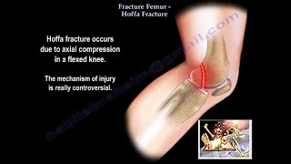 Fracture Femur Hoffa Fracture  Everything You Need To Know  Dr Nabil Ebraheim [upl. by Ytsud894]