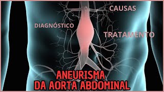 Aneurisma da aorta abdominal  Valores da Enfermagem [upl. by Absa]