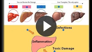 Stages of Liver Damage [upl. by Akitnahs]