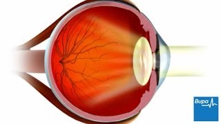 How LASIK eye surgery is carried out [upl. by Joana290]