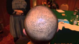 FUE Hair Transplant Hairline Clinic in Turkey 3519 GRAFTS FUE [upl. by Joane757]