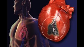 Acute coronary Syndrome ACS and Heart attack STEMI  NSTEMI Unstable angina [upl. by Ghassan]