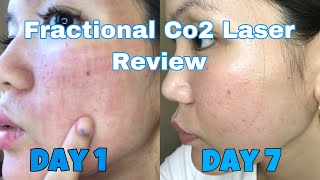 FRACTIONAL CO2 LASER AFTER TREATMENT REVIEW  DAY 1 TO DAY 7  VLOG 5 [upl. by Klaus]