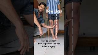 How identify correction of bow legs After surgery bowlegs bowlegsurgery [upl. by Knowles]