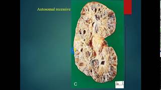 Patho  dr Tahseen  Polycystic Kidney  Adult amp Infantile amp Hydronephrosis باثولوجي [upl. by Iaria]