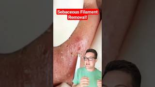 Major BLACKHEAD REMOVAL  Popping Sebaceous Filaments shorts [upl. by Iba]