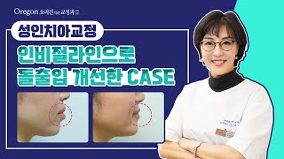 투명치아교정 장치인 【인비절라인】으로 【돌출입증상】개선 가능할까 [upl. by Adnalor]