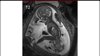 sacrococcygeal teratoma type 1 [upl. by Nonnel]