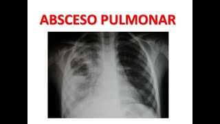 Diagnostico y tratamiento del Absceso Pulmonar MEDICINA INTERNA [upl. by Christianson]