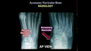 Accessory Navicular Bone  Everything You Need To Know  Dr Nabil Ebraheim [upl. by Milks178]