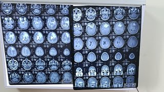 Mastering MRI Findings for Anterior Skull Base Lesions Made Easy [upl. by Gavini]