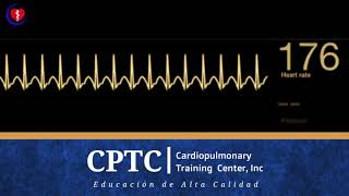 Taquicardia Supraventricular [upl. by Llerrahs]