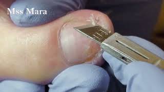 Mss Mara Ep43  Foot Care Clean the Skin and remove the corner of the nail Podología Integral [upl. by Aivital]