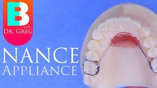 Nance Appliance during Braces [upl. by Attikram246]