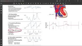 10 JVP In Tricuspid Stenosis [upl. by Julianna]