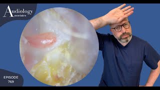 DEAD SKIN REMOVAL amp POLYP IN EAR CANAL  EP769 [upl. by Marola]